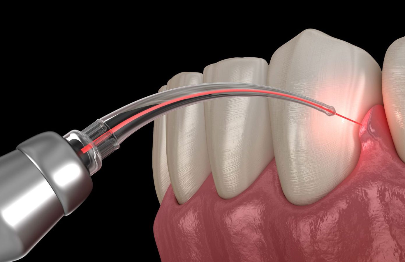 KONA IMPLANTS KONA IMPLANTS